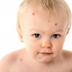 Симптомы аллергии у грудного ребенка и способы ее лечения