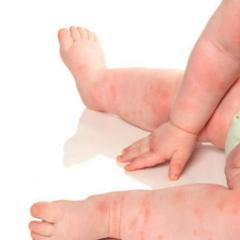 Uşaqda qida allergiyası: təzahürlər, müalicə, allergen məhsulların siyahısı